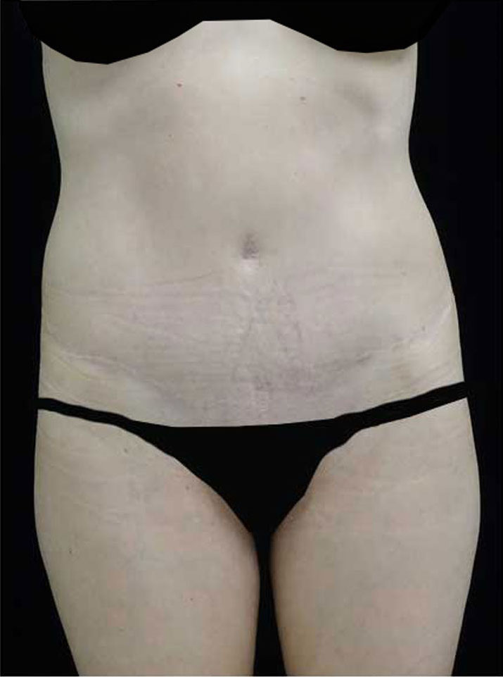 Tummy Tuck Before & After Patient #15062