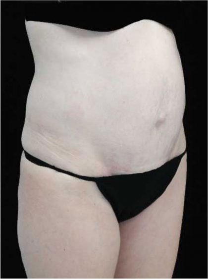 Tummy Tuck Before & After Patient #15062