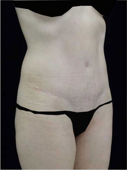 Tummy Tuck Before & After Patient #15062