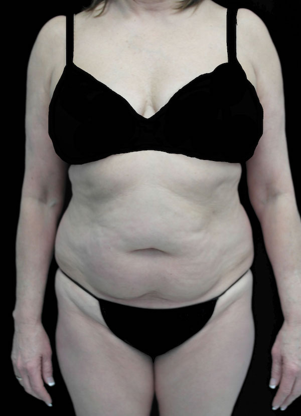 Lipoabdominoplasty Before & After Patient #15111