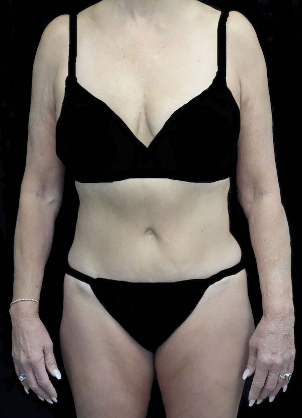 Lipoabdominoplasty Before & After Patient #15111