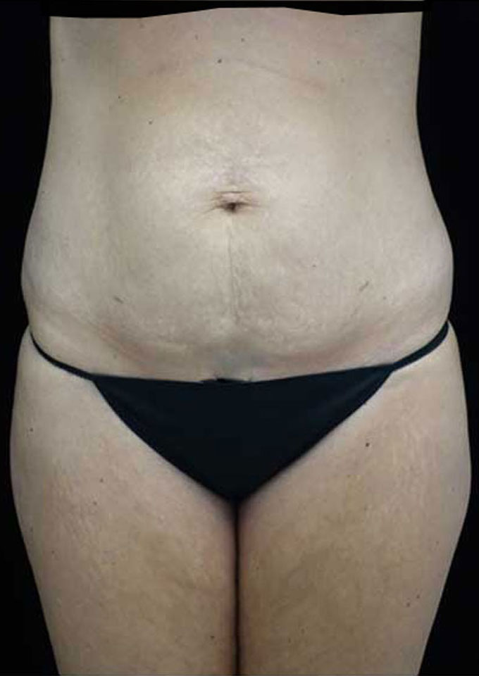 Tummy Tuck Before & After Patient #15145