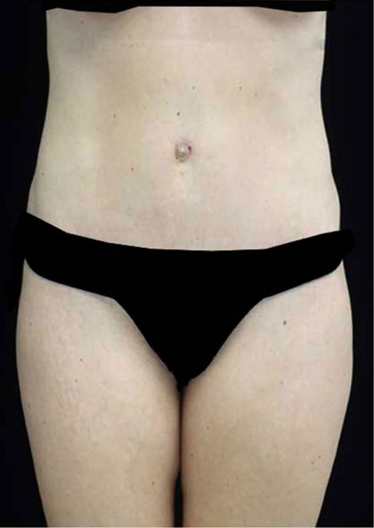 Tummy Tuck Before & After Patient #15145