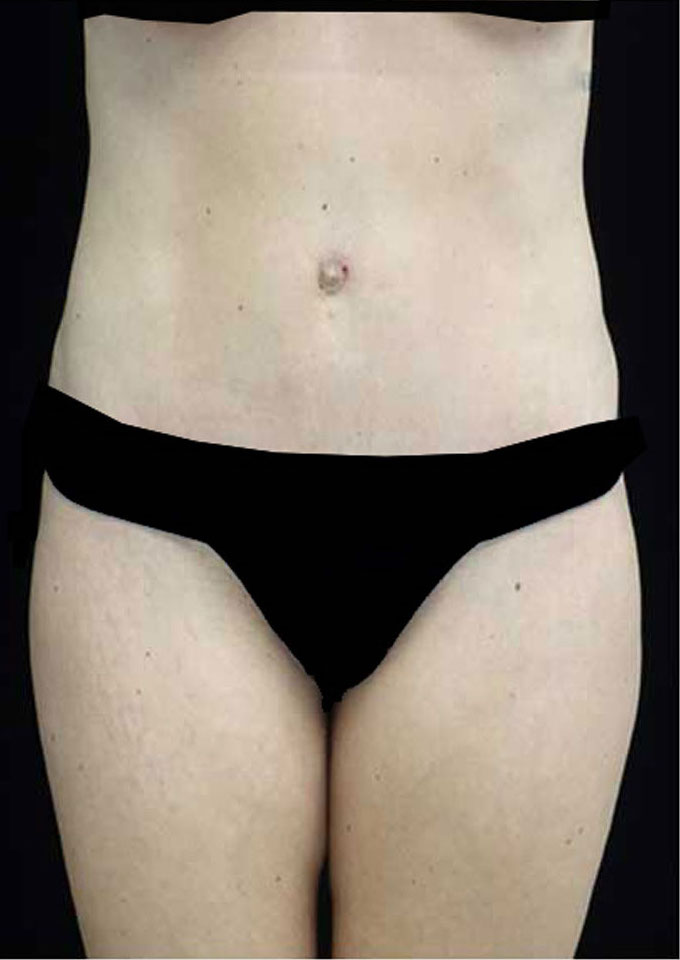 Tummy Tuck Before & After Patient #15145