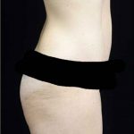 Tummy Tuck Before & After Patient #15145