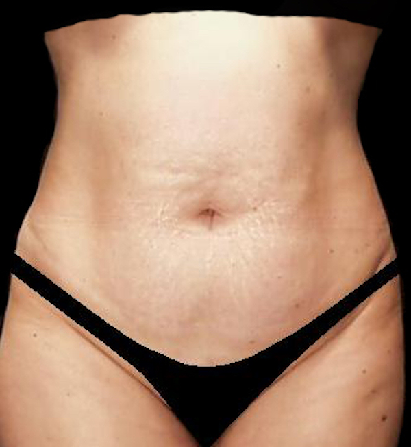 Tummy Tuck Before & After Patient #15174