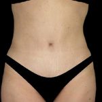 Tummy Tuck Before & After Patient #15174