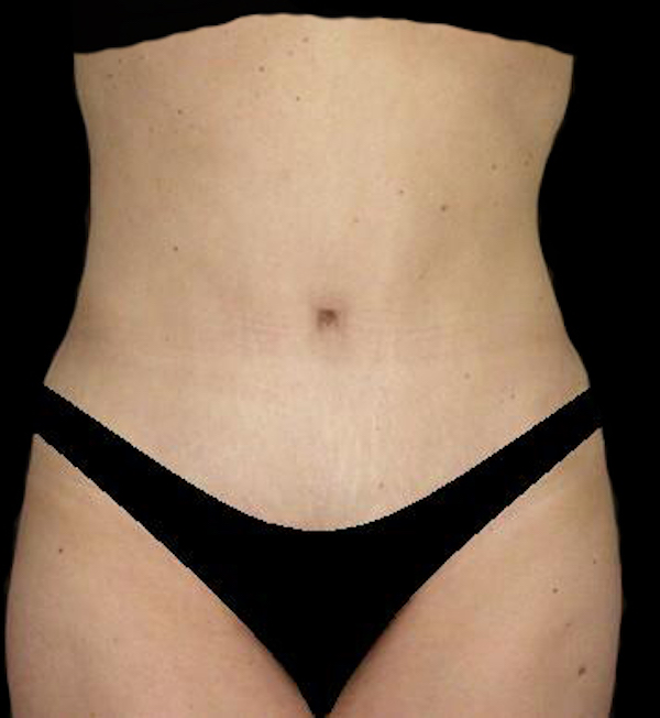 Tummy Tuck Before & After Patient #15174