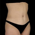 Tummy Tuck Before & After Patient #15174