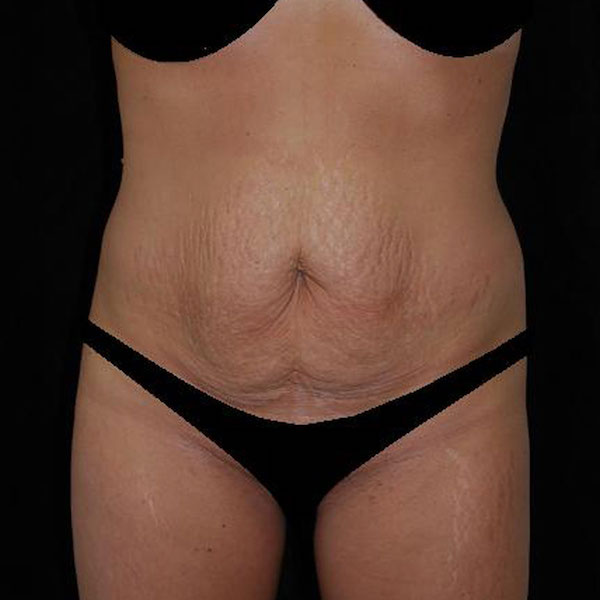 Tummy Tuck Before & After Patient #15181