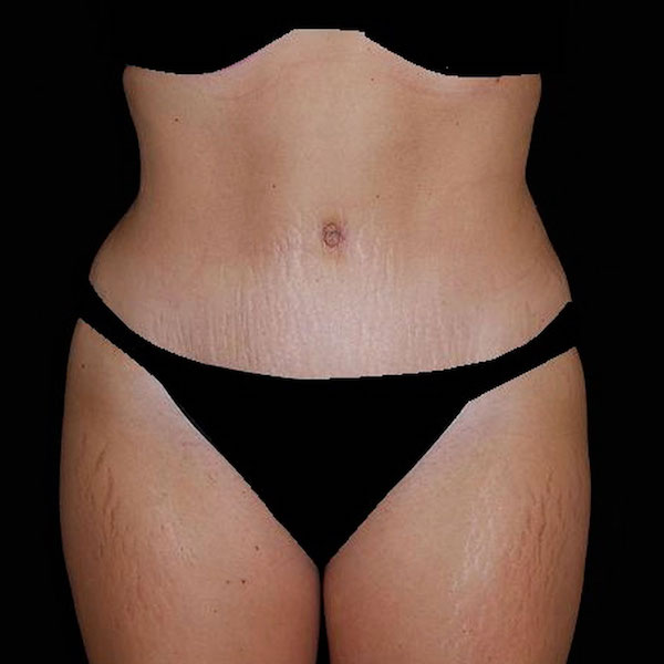 Tummy Tuck Before & After Patient #15181