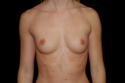 Breast Augmentation (Implants) Before & After Patient #14061