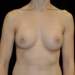 Breast Augmentation (Implants) Before & After Patient #14046