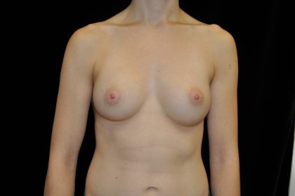 Breast Augmentation (Implants) Before & After Patient #14046