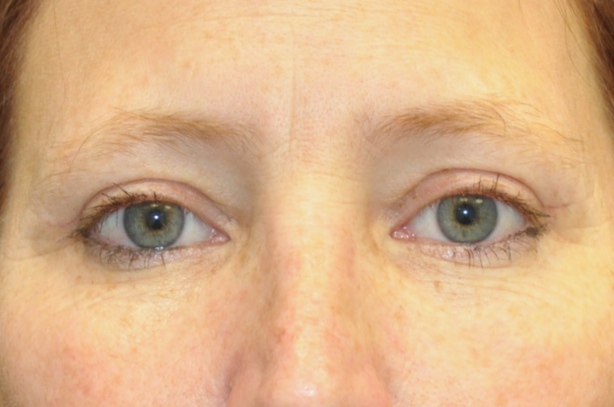 Blepharoplasty Before & After Patient #13928