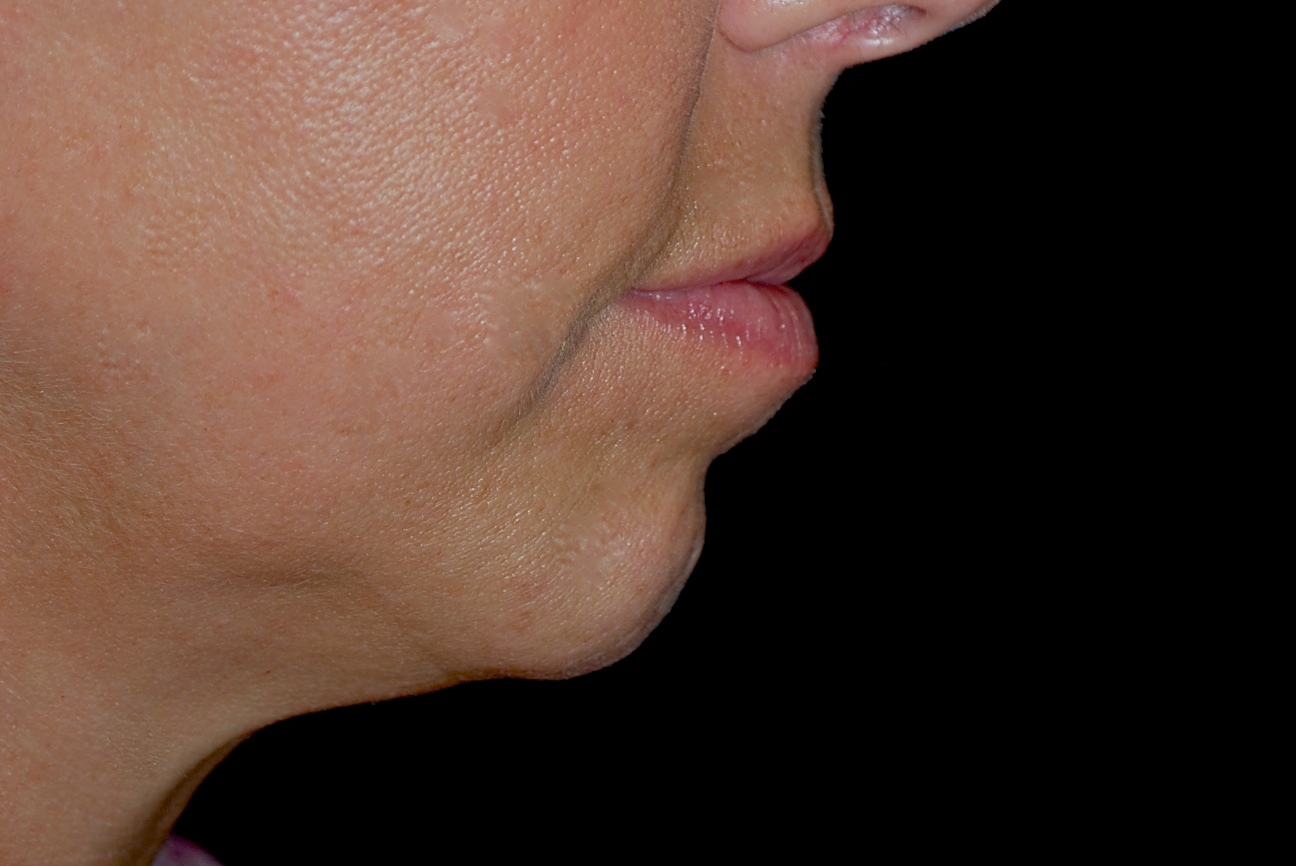 Chin & Jawline Filler Before & After Patient #14845