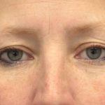 Blepharoplasty Before & After Patient #13928
