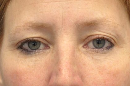Blepharoplasty Before & After Patient #13928