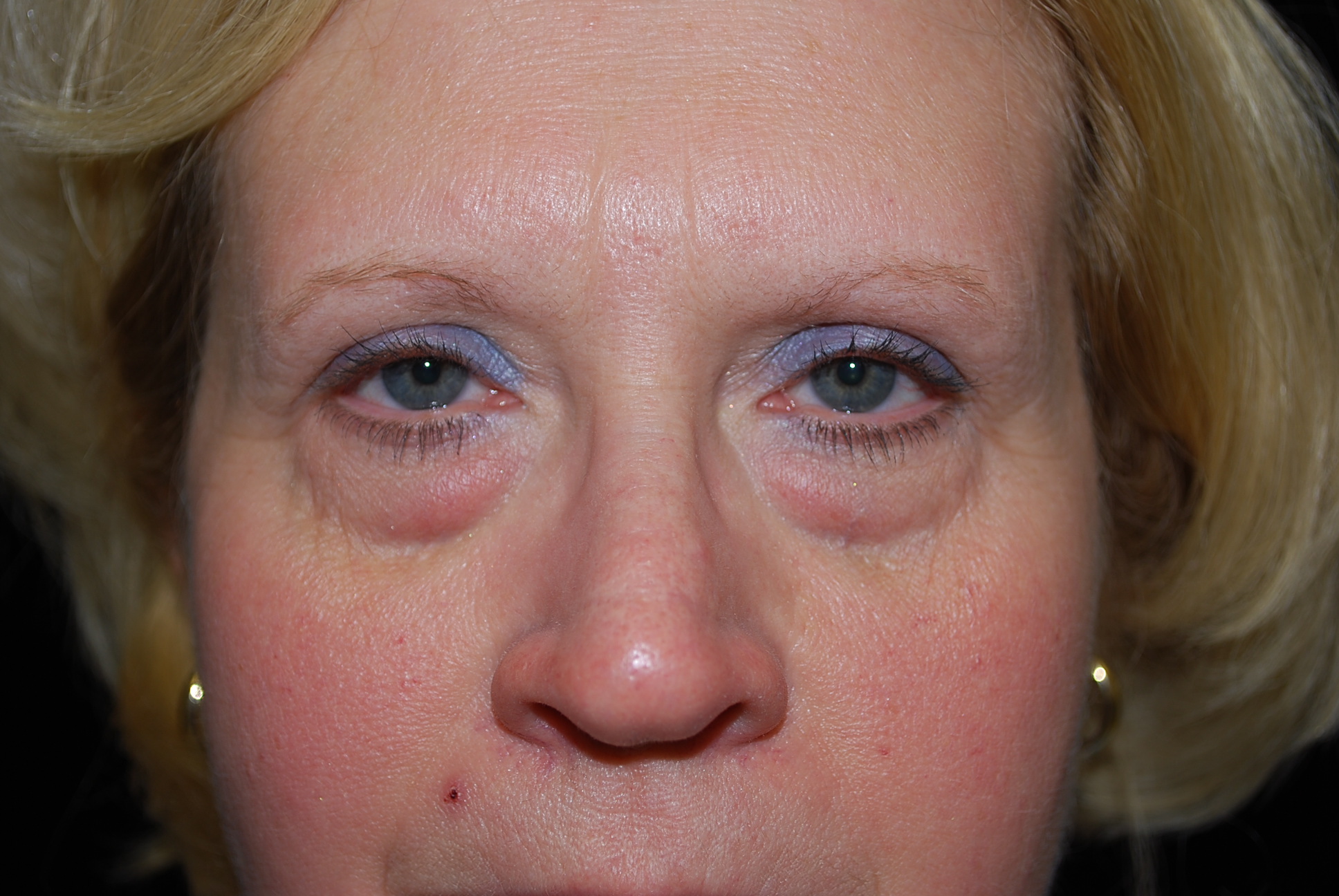 Blepharoplasty Before & After Patient #13905
