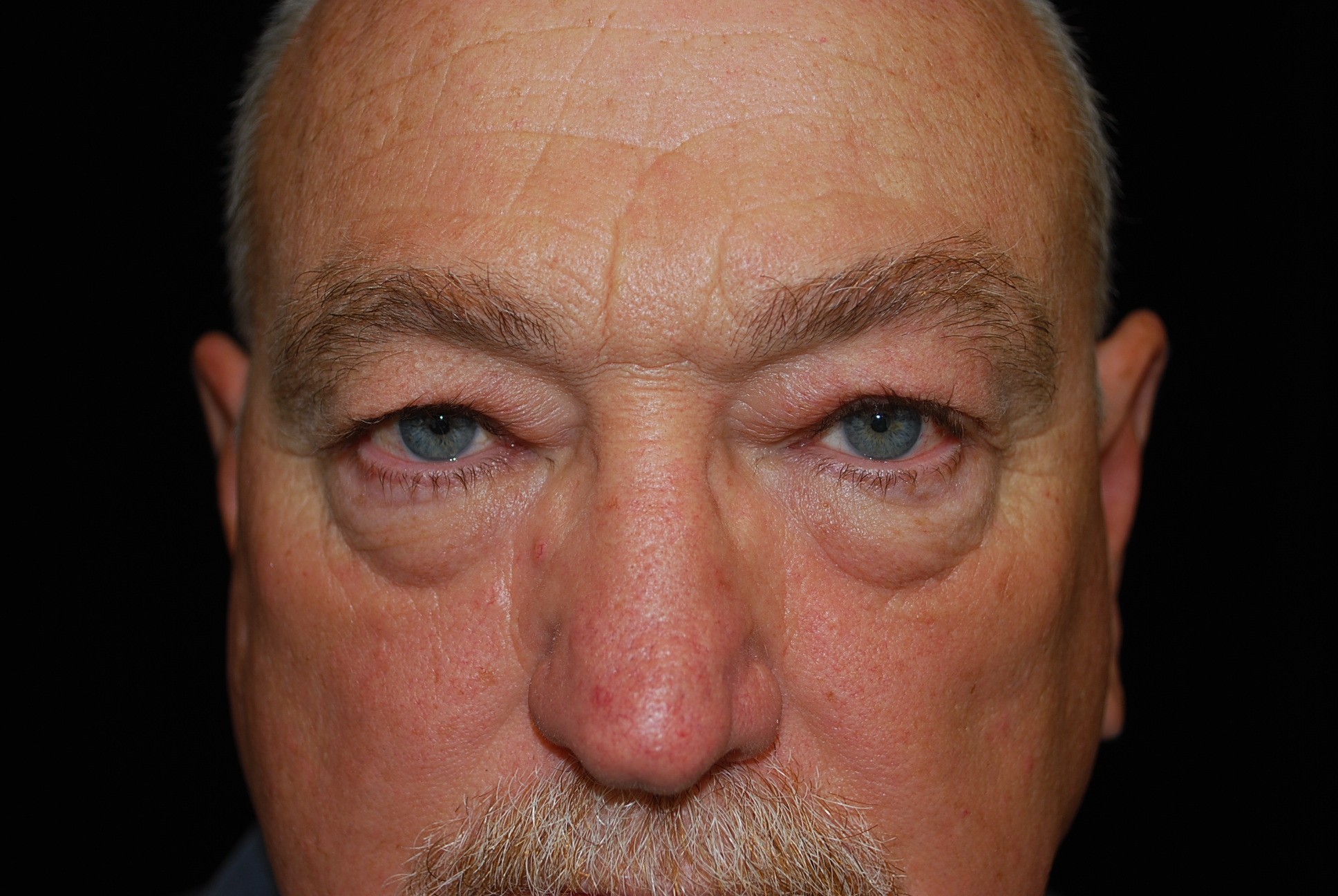 Blepharoplasty Before & After Patient #13885