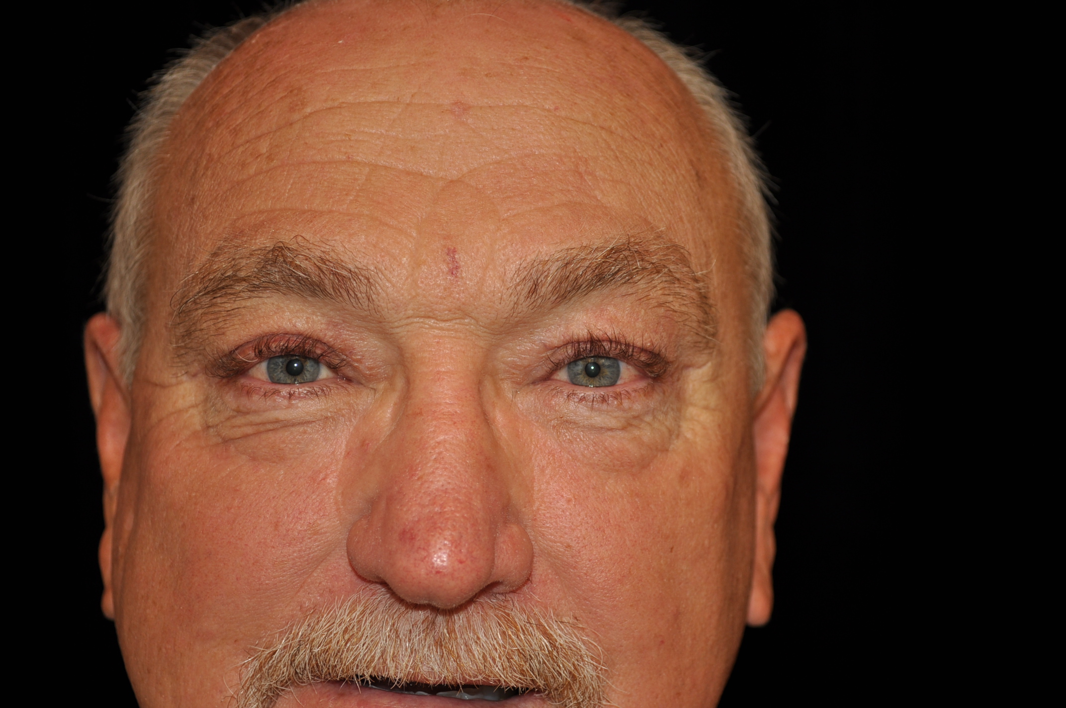 Blepharoplasty Before & After Patient #13885
