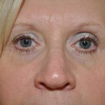 Blepharoplasty Before & After Patient #13905