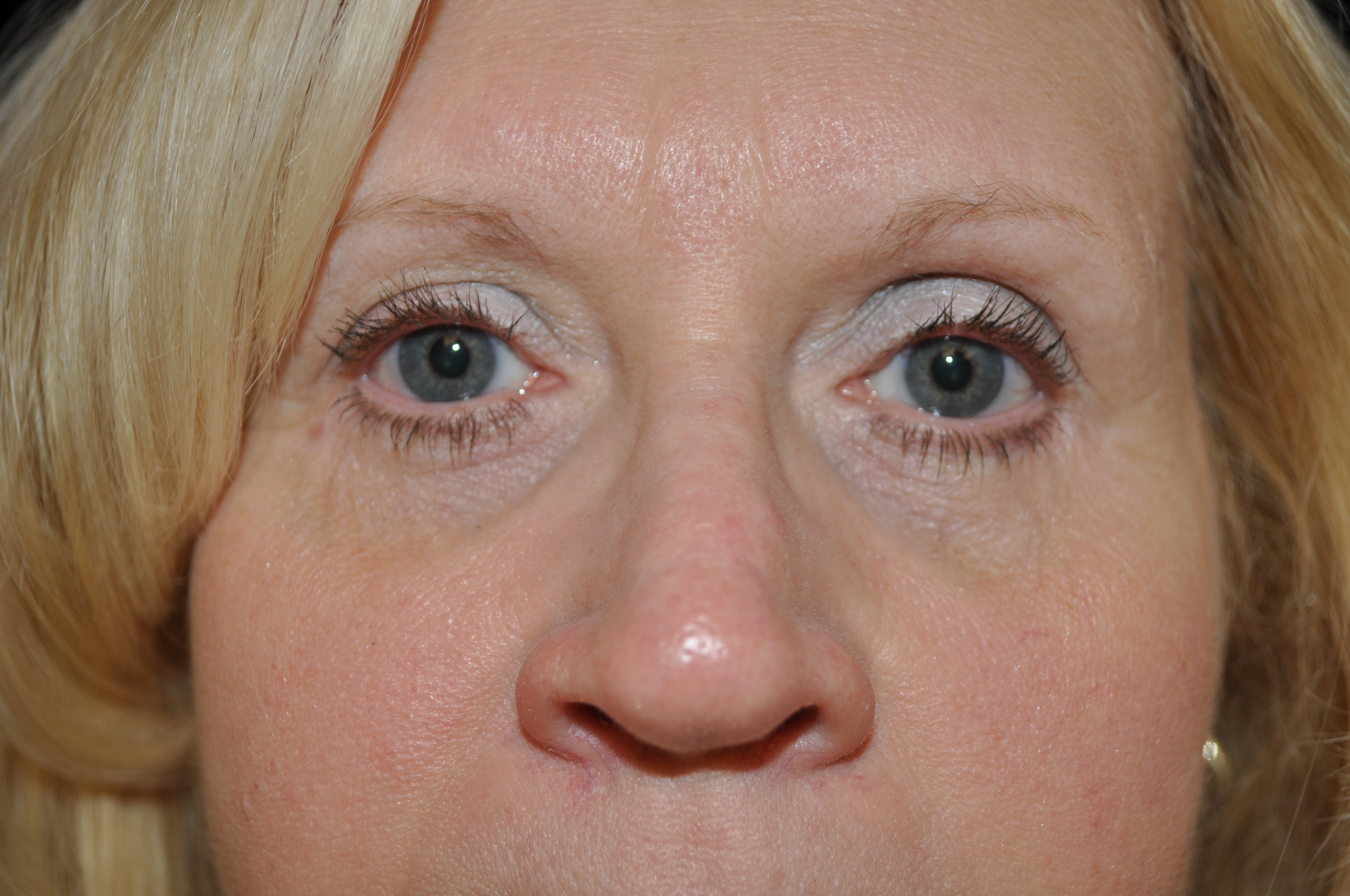 Blepharoplasty Before & After Patient #13905