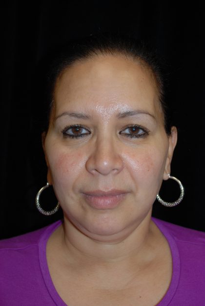 Chin Implants Before & After Patient #14806