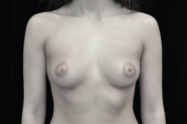 Breast Augmentation (Implants) Before & After Patient #14106