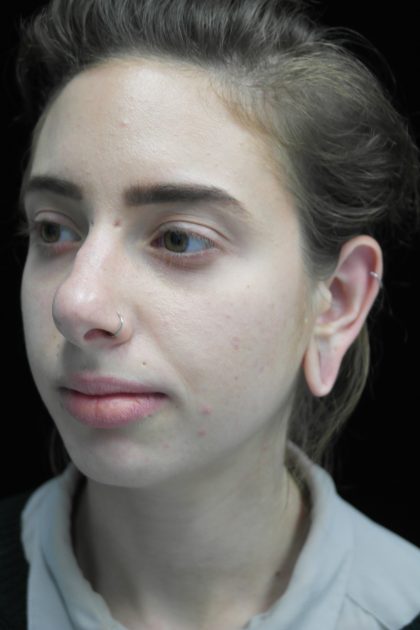 Chin Implants Before & After Patient #14786