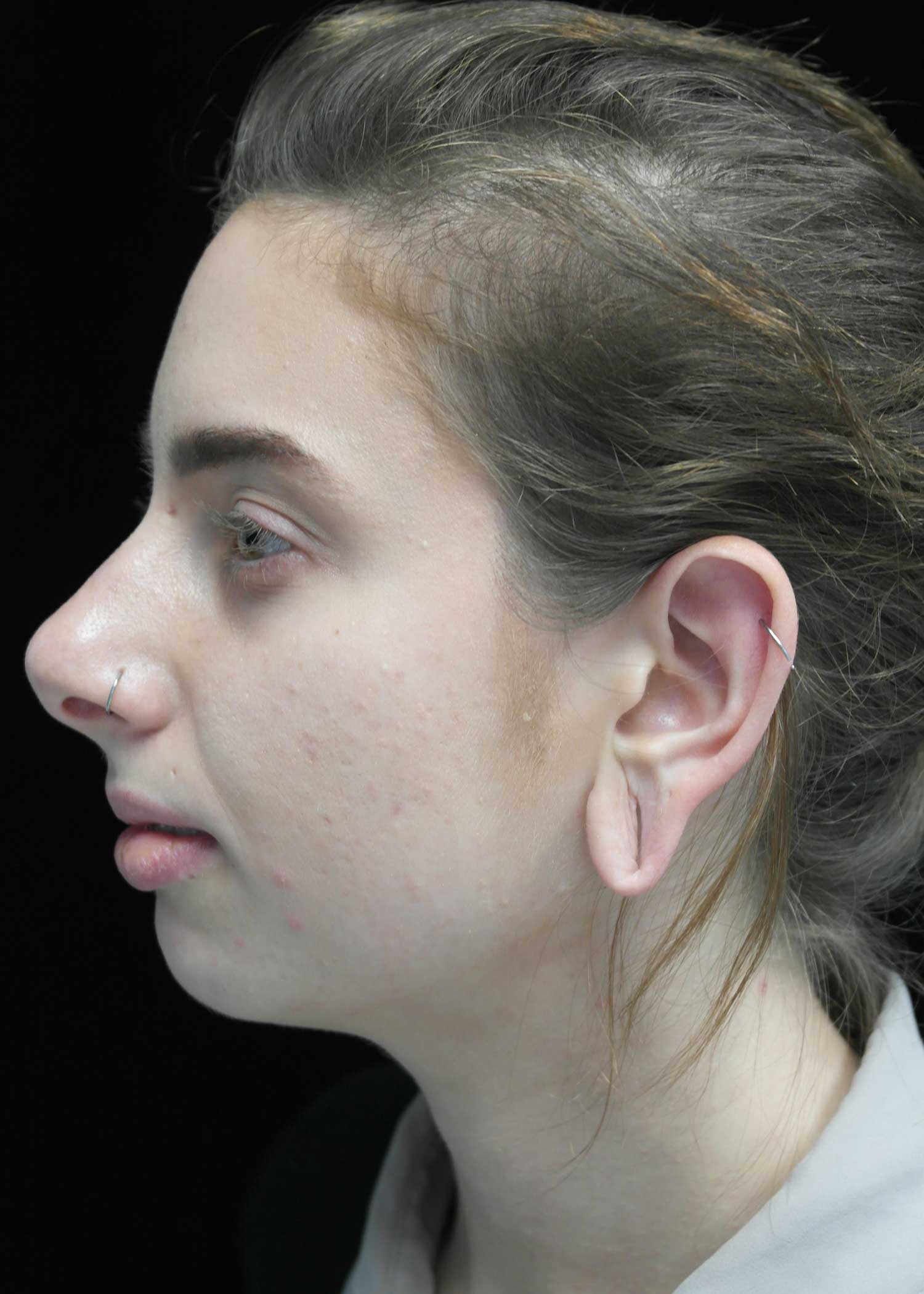 Chin Implants (Augmentation) Before & After Patient #14786