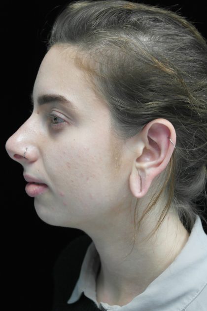 Chin Implants Before & After Patient #14786