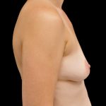 Breast Augmentation (Implants) Before & After Patient #14113