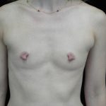 Breast Augmentation (Implants) Before & After Patient #14020
