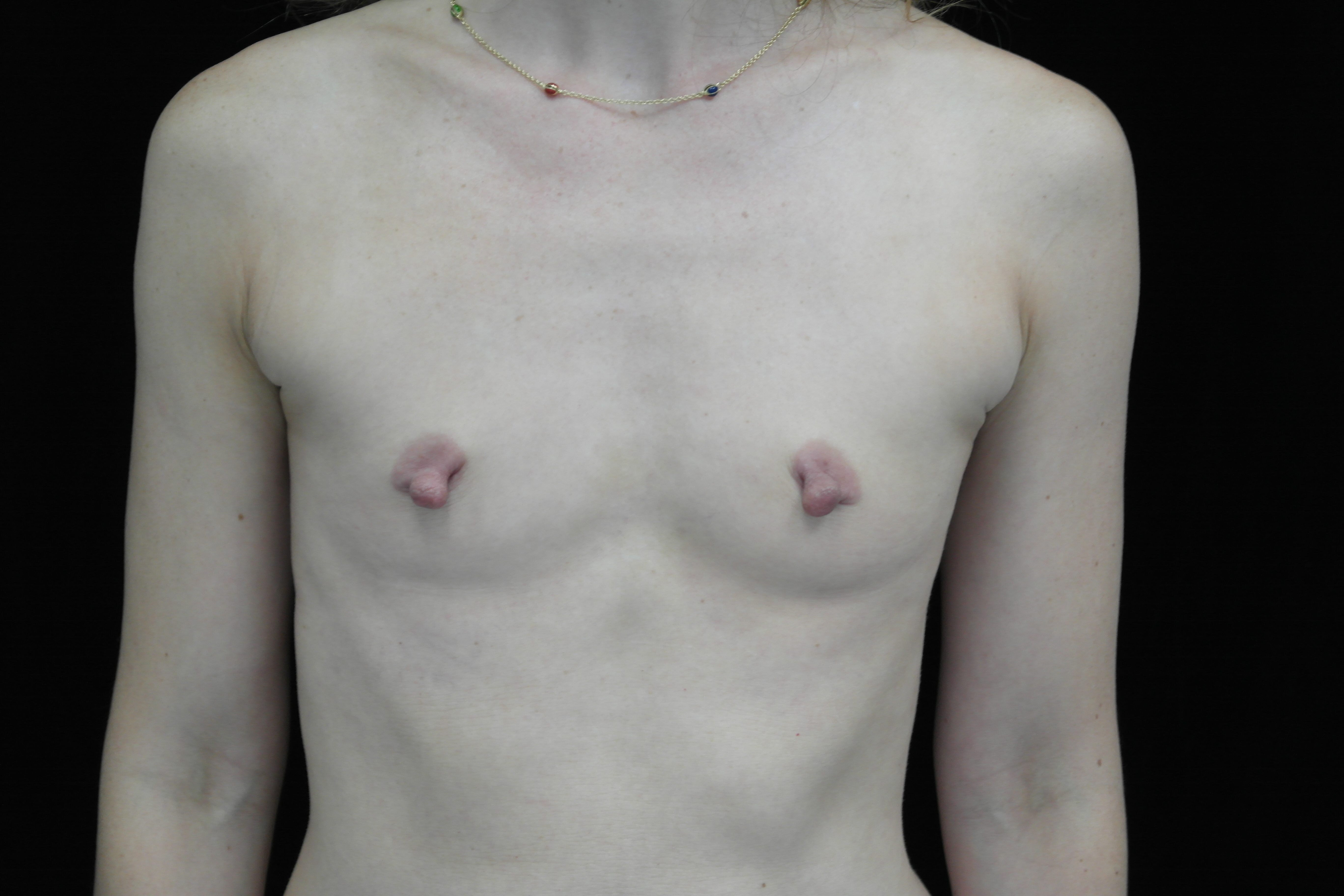 Breast Augmentation (Implants) Before & After Patient #14020