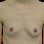 Breast Augmentation (Fat Transfer) Before & After Patient #13991