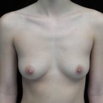 Breast Augmentation (Implants) Before & After Patient #14027