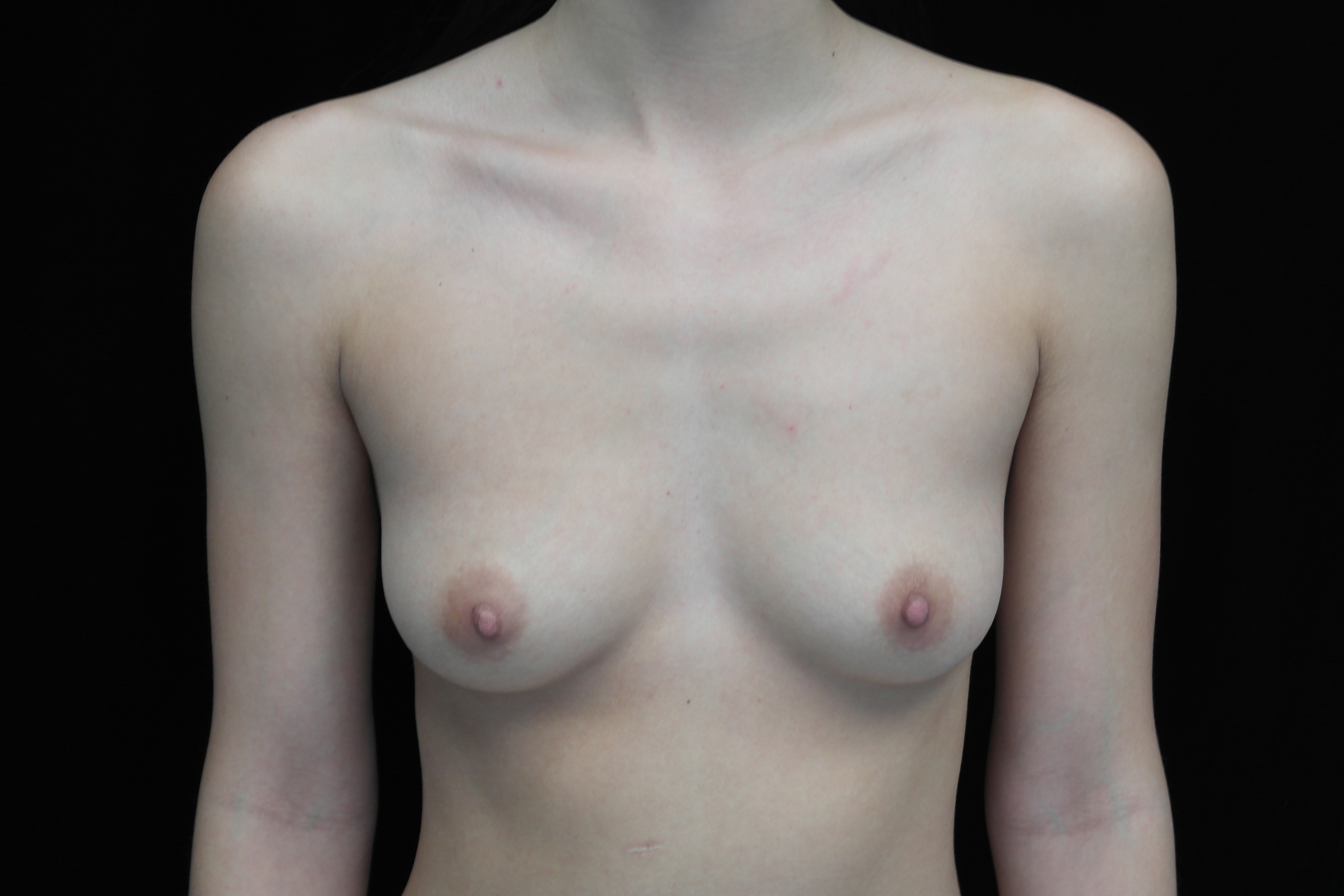Breast Augmentation (Implants) Before & After Patient #14027