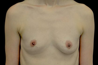 Breast Augmentation (Fat Transfer) Before & After Patient #13991
