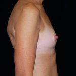 Breast Augmentation (Implants) Before & After Patient #14277