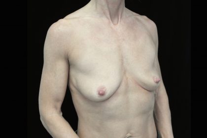 Breast Augmentation (Implants) Before & After Patient #14293
