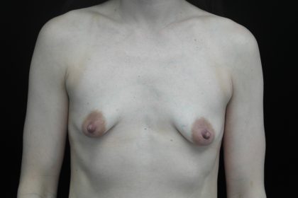 Breast Augmentation (Implants) Before & After Patient #14383
