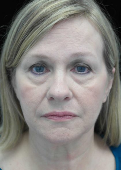 Facelift Before & After Patient #14832