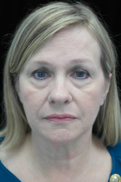 Facelift Before & After Patient #14832