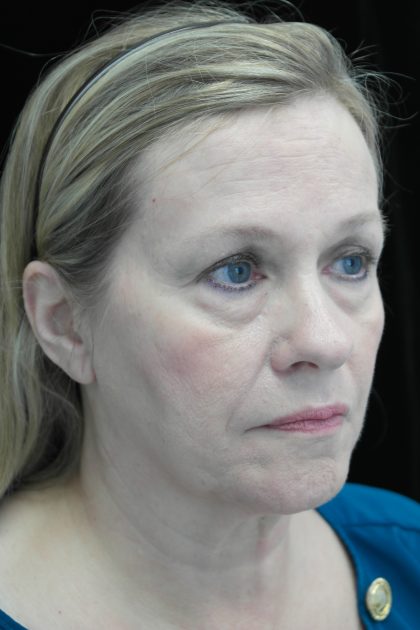 Facelift Before & After Patient #14832