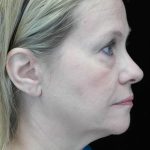Facelift Before & After Patient #14832