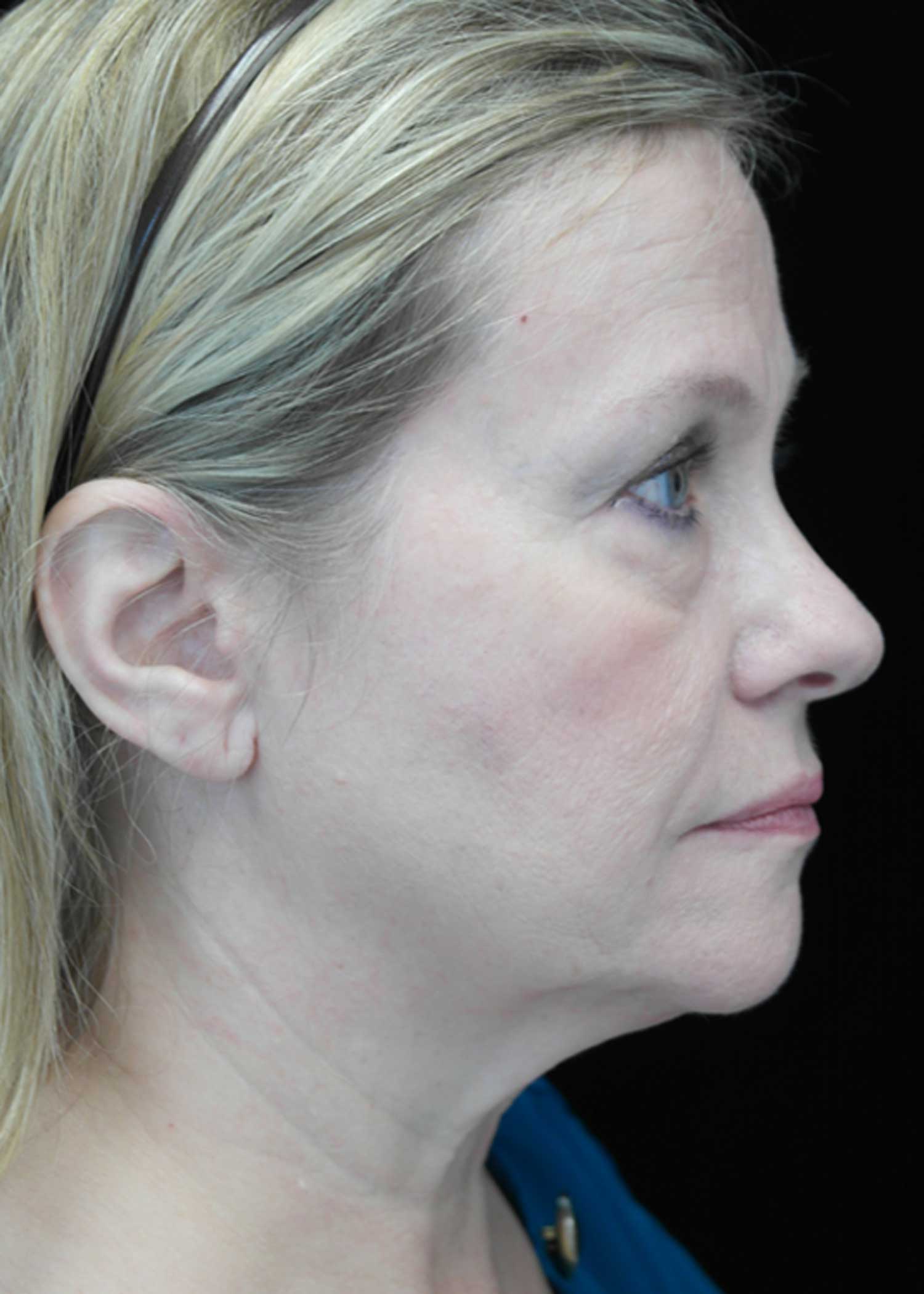Facelift Before & After Patient #14832