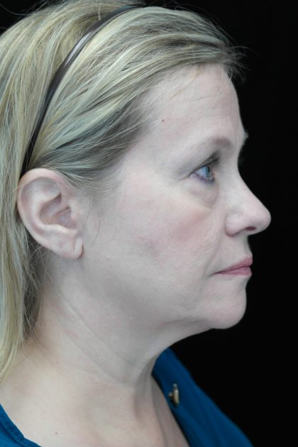 Facelift Before & After Patient #14832