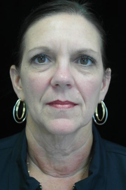 Facelift Before & After Patient #14876