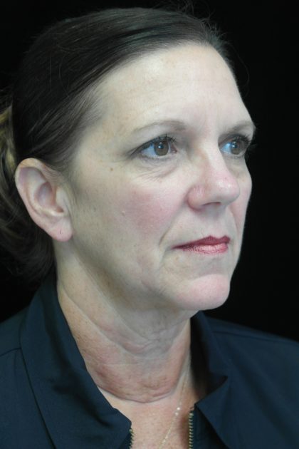 Facelift Before & After Patient #14876